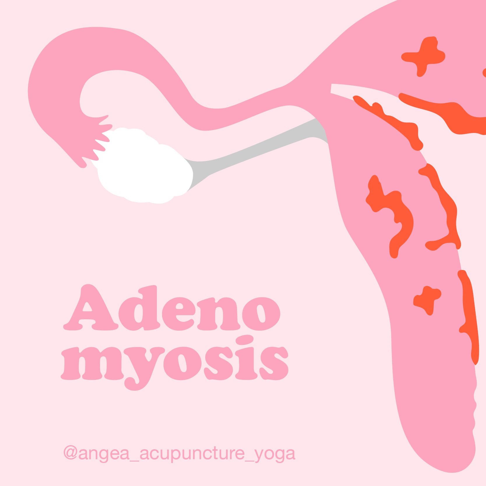 Medical illustration of adenomyosis explaining how the condition affects the uterus, myometrium, blood flow, hormones, and the female reproductive system.
