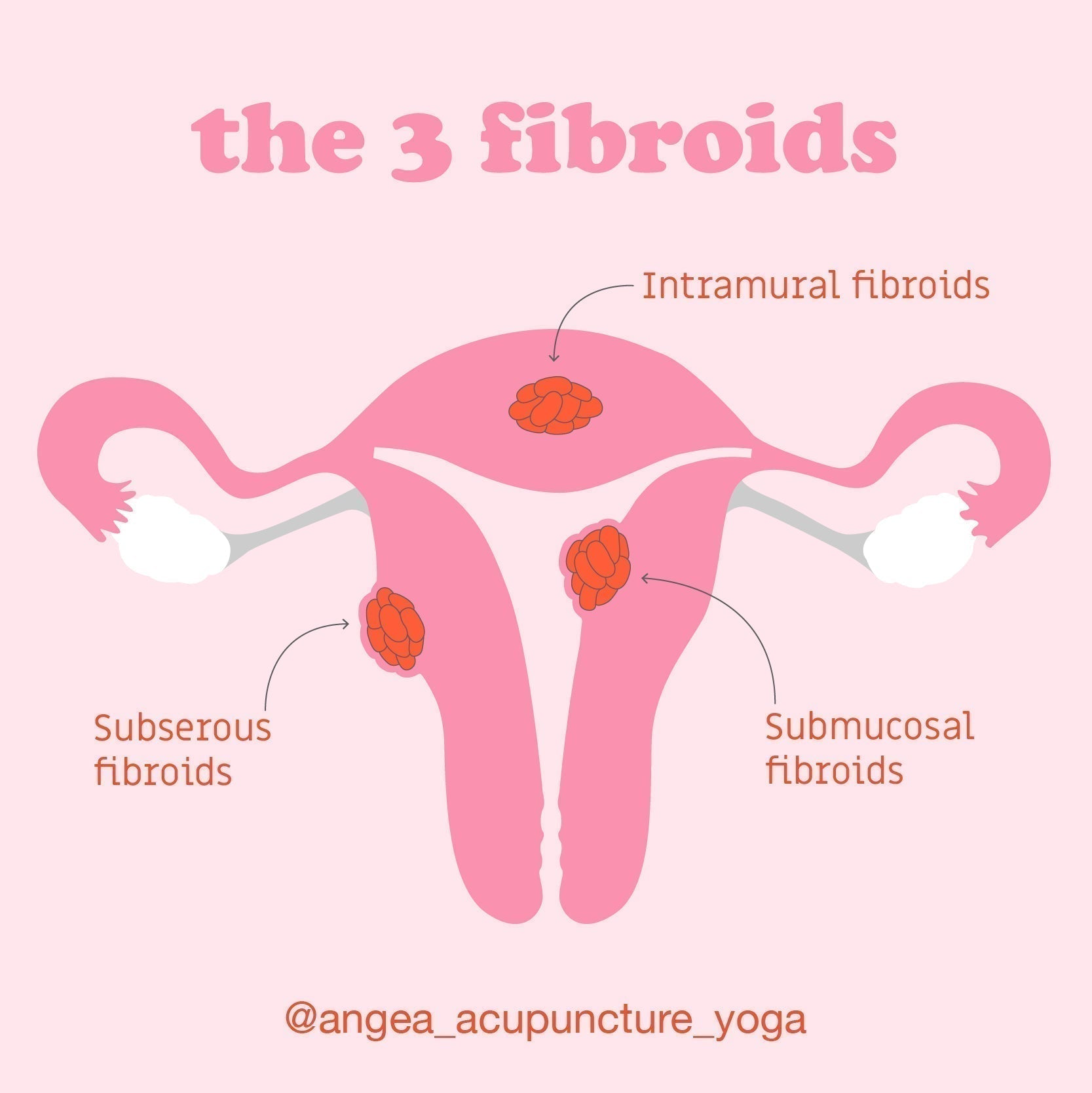 Uterine fibroids illustration identifying intramural, submucosal, and subserosal fibroids to explain fibroid growth, menstrual health, and fertility.