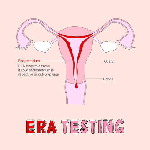 IVF And ERA Testing – Endometrial Receptivity Assay