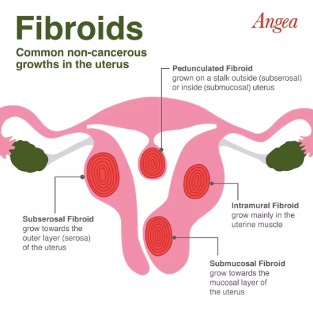 Medical illustration explaining uterine fibroids, their types, symptoms, causes, and impact on women's reproductive health and fertility.